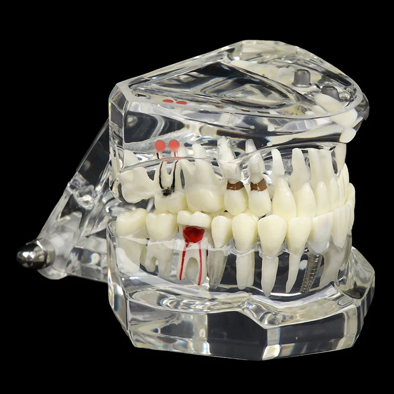 Dental Implant Teaching Model – Teeth Restoration Bridge Study