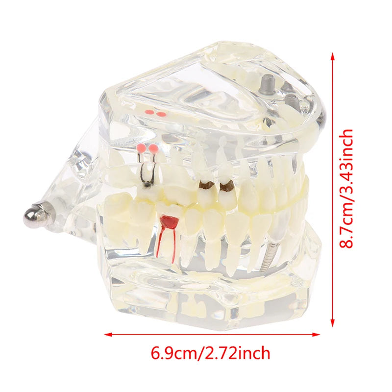 Dental Implant Teaching Model – Teeth Restoration Bridge Study