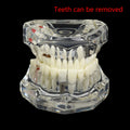 Dental Implant Teaching Model – Teeth Restoration Bridge Study