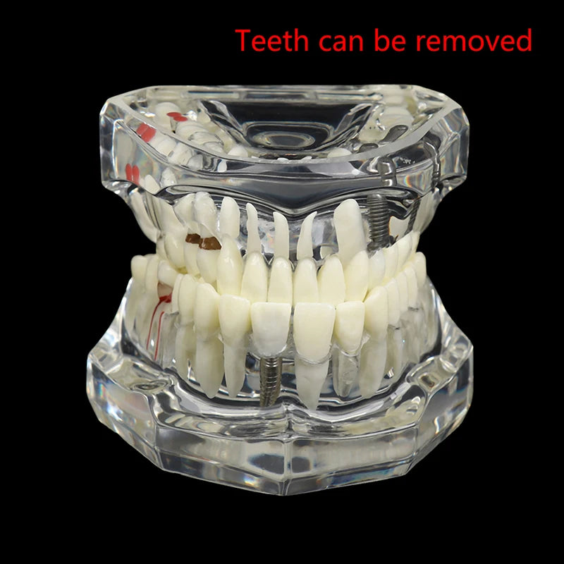 Dental Implant Teaching Model – Teeth Restoration Bridge Study
