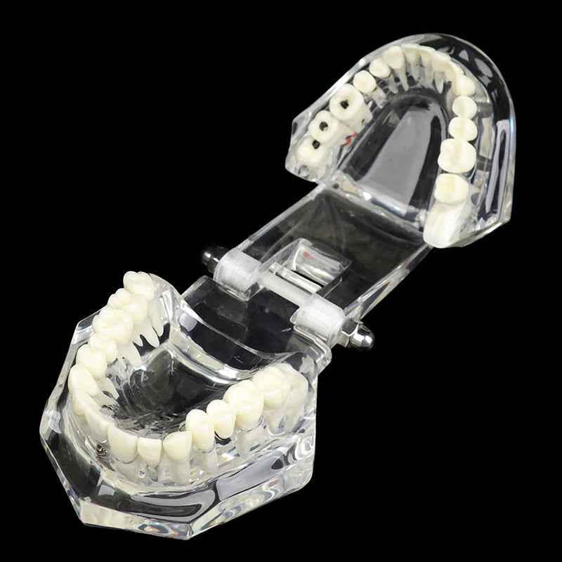 Dental Implant Teaching Model – Teeth Restoration Bridge Study