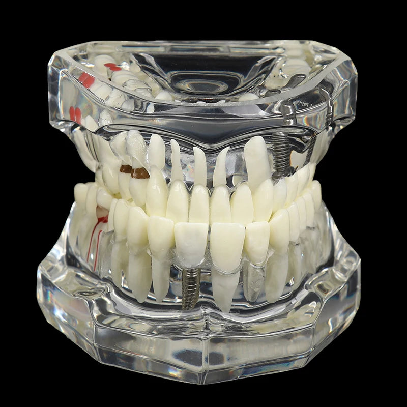Dental Implant Teaching Model – Teeth Restoration Bridge Study