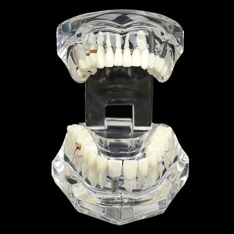 Dental Implant Teaching Model – Teeth Restoration Bridge Study